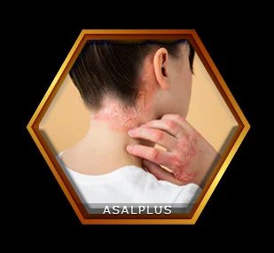 تسکین عفونت های پوستی مقاوم با عسل طبیعی عسل پلاس asalplus.com relief of mrsa skin infections with honey