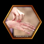 درمان اگزما با عسل طبیعی عسل پلاس asalplus.com eczema relief with honey
