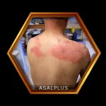 درمان زخم ها و سوختگی ها با عسل طبیعی عسل پلاس asalplus.com burn wound healing with honey