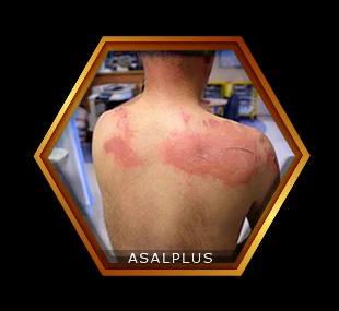 درمان زخم ها و سوختگی ها با عسل طبیعی عسل پلاس asalplus.com burn wound healing with honey
