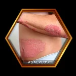 درمان پسوریازیس با عسل طبیعی عسل پلاس psoriasis treatment with honey