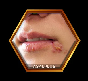 کمک به درمان تبخال با عسل طبیعی عسل پلاس asalplus.com herpes treatment with honey